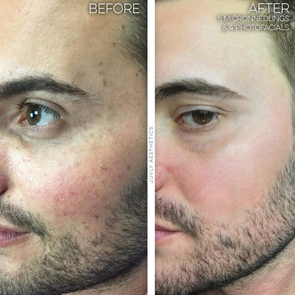 IPL-BBL-Microneedling-man